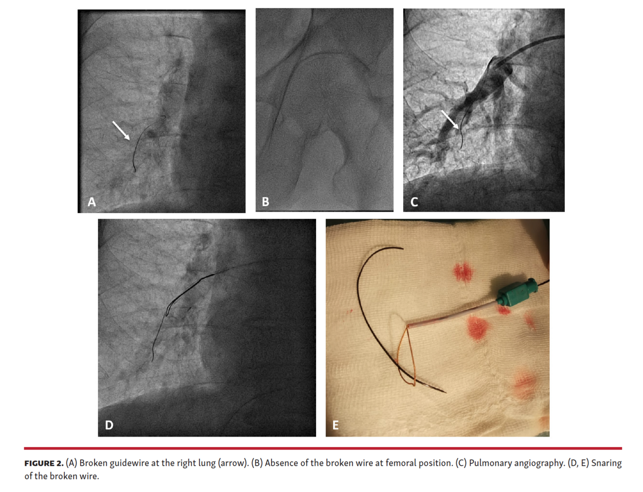 Traveling Wire After Chronic Total Occlusion Percutaneous Coronary